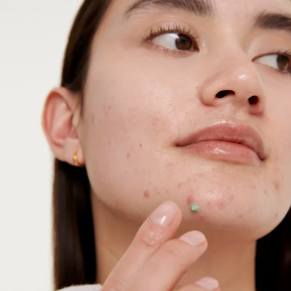 The Inkey List Succinic Acid Acne Treatment 15 ml - Image 6